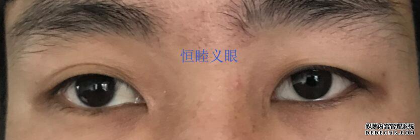 林先生佩戴更換義眼片，保留眼球，眼球萎縮